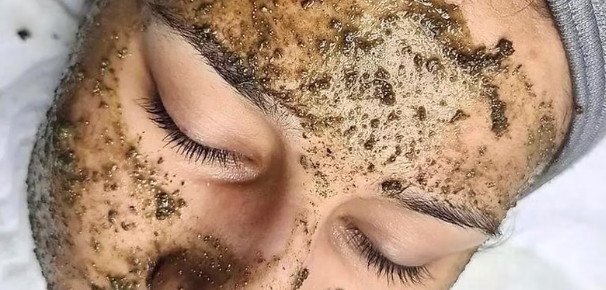 Algae Peel in Birmingham