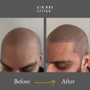 smp (scalp micropigmentation) results, before and after 4