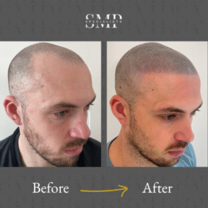 smp (scalp micropigmentation) results, before and after 3