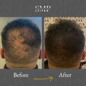 smp (scalp micropigmentation) results, before and after 2