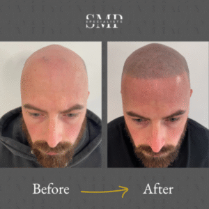 smp (scalp micropigmentation) results, before and after 1