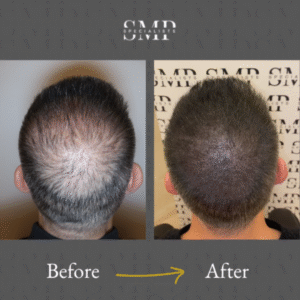 smp (scalp micropigmentation) results, before and after 7
