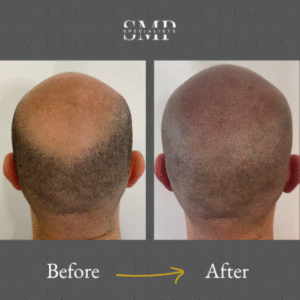 smp (scalp micropigmentation) results, before and after 6