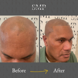 smp (scalp micropigmentation) results, before and after 5